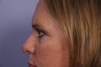 Eyelid Surgery after 306450