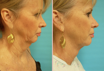 Jawline / Neck Lipo before 293427