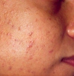PDT for acne before 376134
