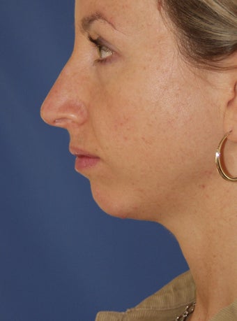 Chin Implant 414149