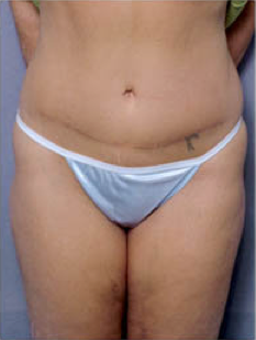 Tummy Tuck after 428194