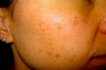 IPL for Acne before 374388