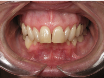 Adult Overbite, Nonextraction (braces) before 296520