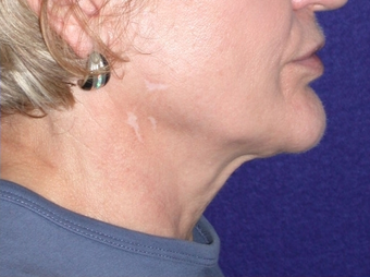 Necklift 208457