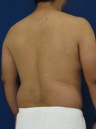 Vaser Hi Def Liposuction of chest, abdomen, back and flanks 422695
