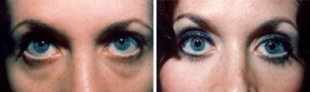 Blepharoplasty-Mid Face before 319402