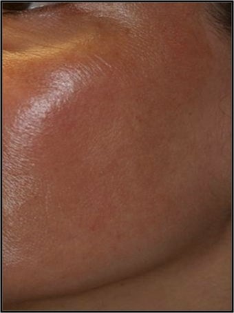Fraxel - Melasma after 652321