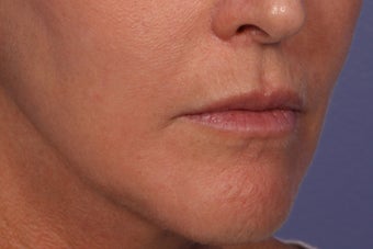Botox and Juvederm Ultra Plus to Upper Lip 308354