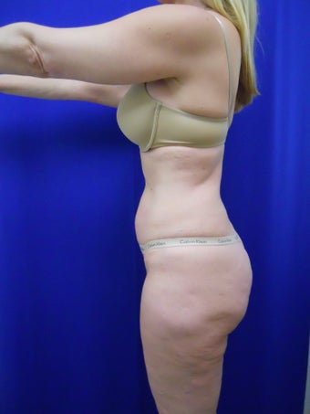 Zerona before 338871