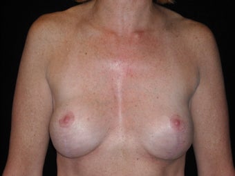 Removal and replacement of breast implants and breast lift after 237757