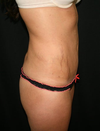 Abdominplasty (mini tummy tuck) after 263059