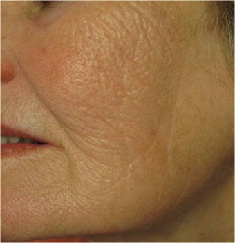 Evolastin- Non Surgical Lift after 498659