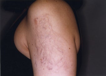 Laser Tattoo Removal after 628898