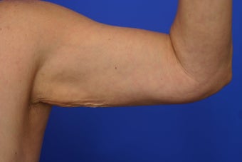 Arm lift before 461867