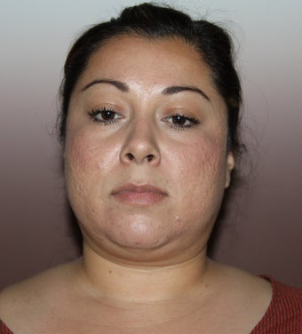 Lipocontouring of the neck before 606683
