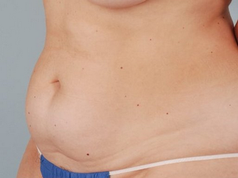 Smart Lipo before 100342