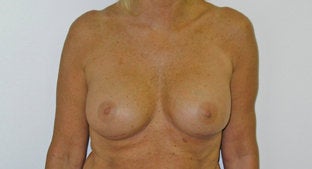Implant Correction after 494513