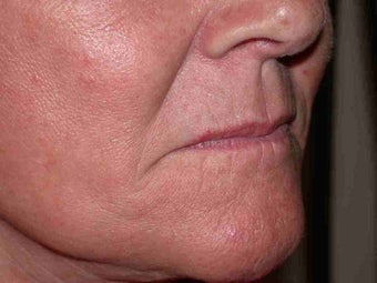 Juvederm to corners of the mouth and Botox to DAO before 100156