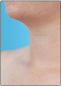 Smart Lipo, Neck Liposuction after 607447