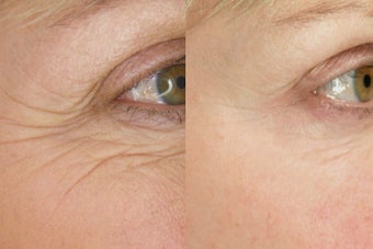 Botox for Wrinkle Treatment before 100337