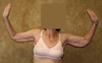 Brachioplasty or arm tuck in los angeles after 583676