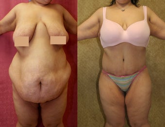 tummy tuck 304693