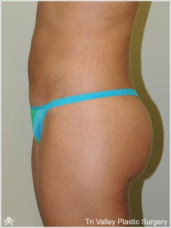 Brazilian Buttock Lift after 420880