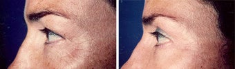 Blepharoplasty before 643245