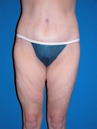 Body Lift after 212173