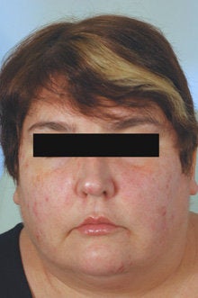 Botox and Restylane for Mouth Frown before 91054