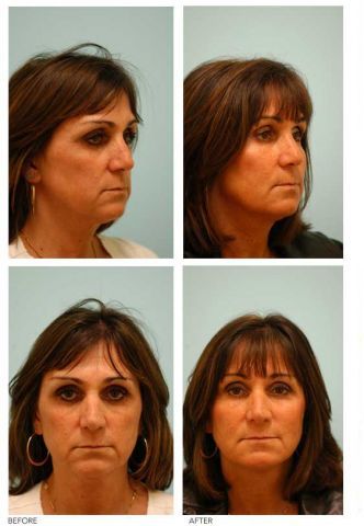 Fat Transfer/Fat Grafting/Facial Rejuvenation before 136362