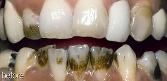 Teeth Whitening Smoking before 234630
