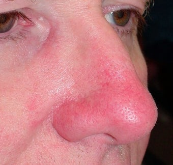 PDL for nose veins after 374576