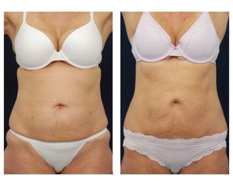 Liposuction before 495483