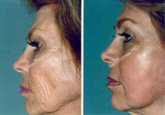 Non-Surgical Face Lift- Exoderm before 242977