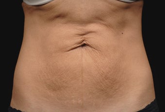 Body contouring before 380982