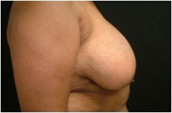 Breast Reduction before 205103