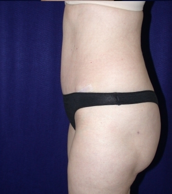 Tummy Tuck (abdominoplasty) 208465
