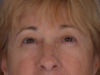 Eyelid Surgery before 306434
