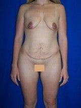 Breast Lift with Implants, Mommy Makeover, Tummy Tuck (Abdominoplasty) before 412072