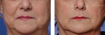 Restylane before 110128