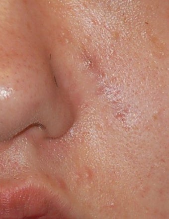 Lesion Removal, Excision after 134447