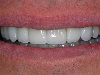 Porcelain Veneers 366635
