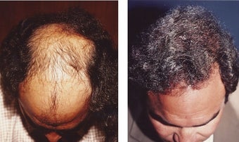 hair transplant after 369170
