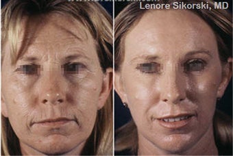 Laser Resurfacing before 106311