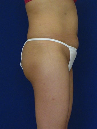 Vaser Hi Def Liposuction of the back and flanks with fat injections to the buttocks 422742
