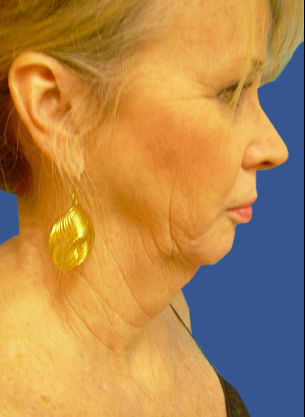 Jawline / Neck Lipo before 491293