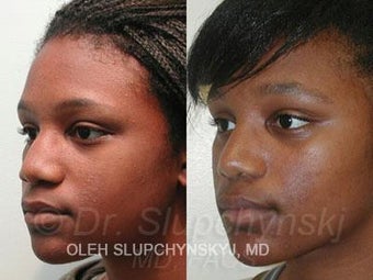 African American Rhinoplasty after 374013