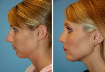 Chin Implant, Rhinoplasty before 91943