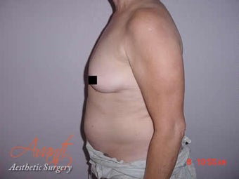 Body Jet before 379522